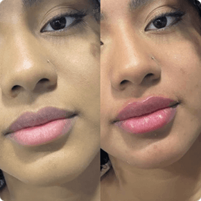 Preenchimento labial