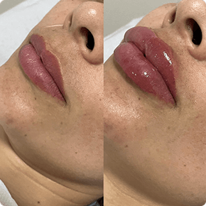 Preenchimento labial
