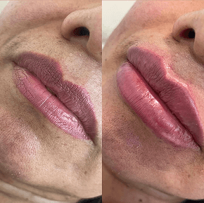 Preenchimento Labial