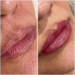 Preenchimento Labial