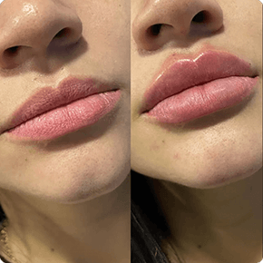 Preenchimento labial